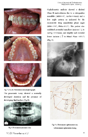 Safety of interproximal enamel reduction: A Further Confirmation