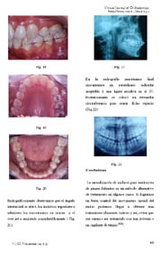 Mesialización de un segundo molar inferior sustituyendo un primer molar: Presentación de un caso clìnico ortodóntico