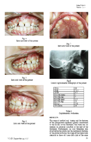 Unilateral Cleft Palate, a case report.