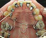 Auxiliares in lingual orthodontic
